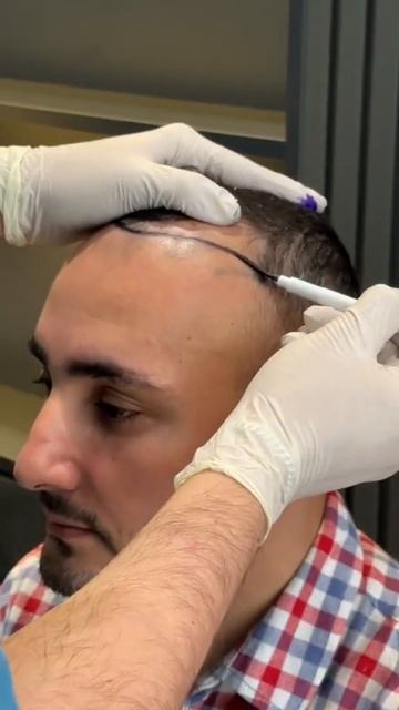 Hair transplant in Turkey l Пересадка волос  #hairtransplantturkey #пересадк?