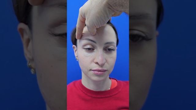Эндоскопическая подтяжка верхней трети лица и риносептопластика. Сложная форма носа❗️