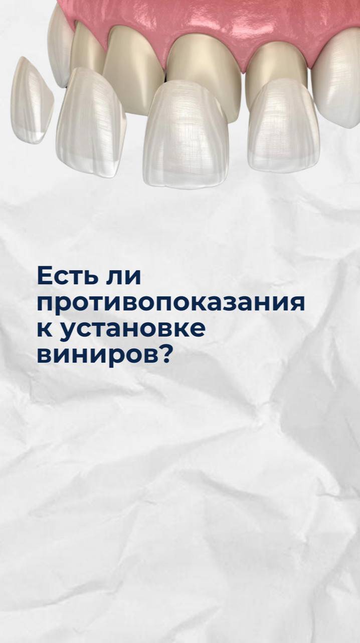 Есть ли противопоказания к установке виниров.