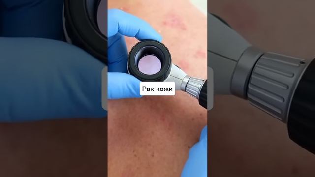 Какие бываю первые признаки рака #хочуфакты
