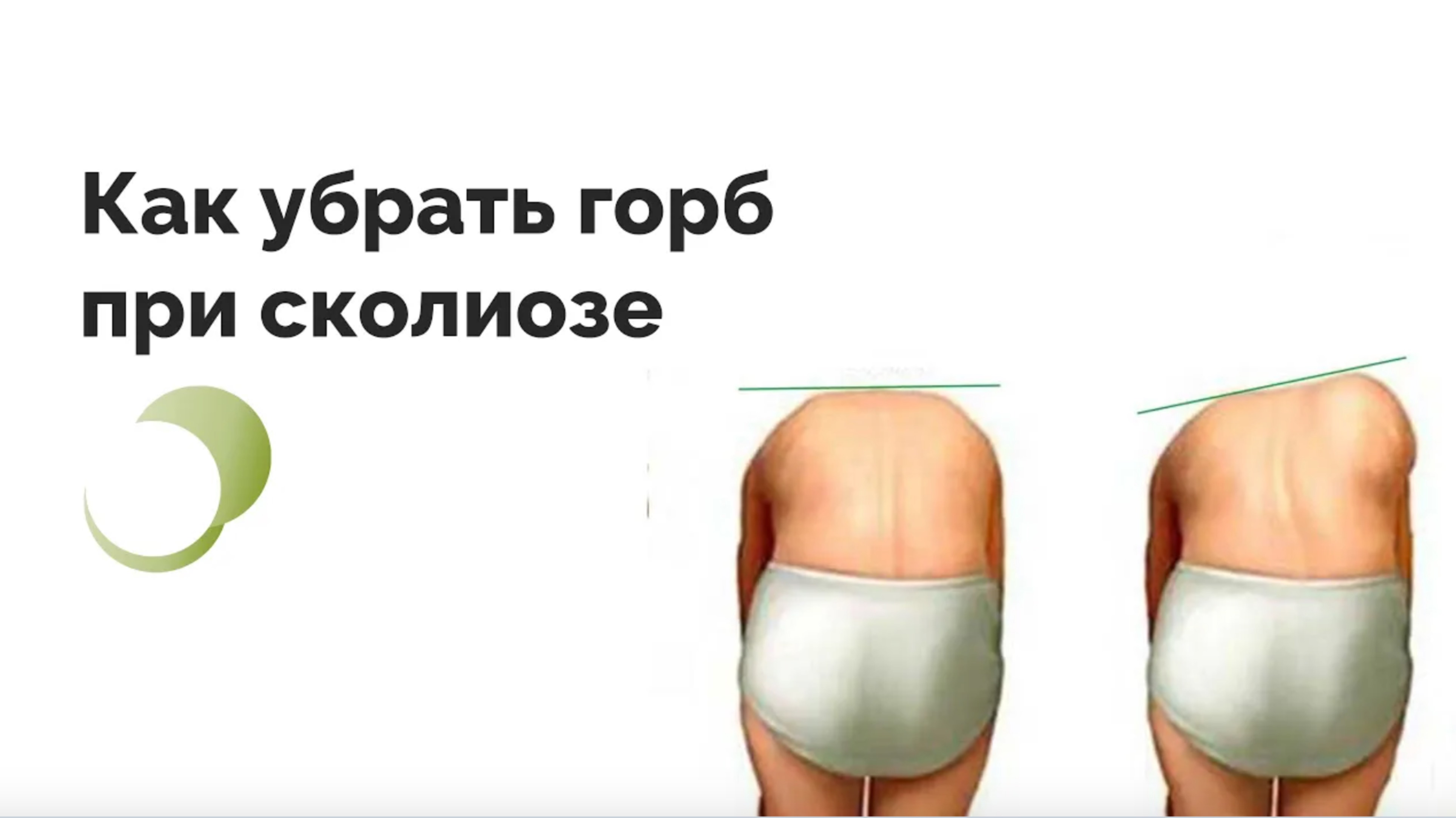 Реберный горб почему при сколиозе спина выглядит некрасиво