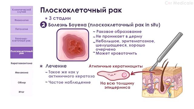 Новообразования кожи обзорно_ меланома, плоскоклеточный и базальноклеточный рак, кератоакантома