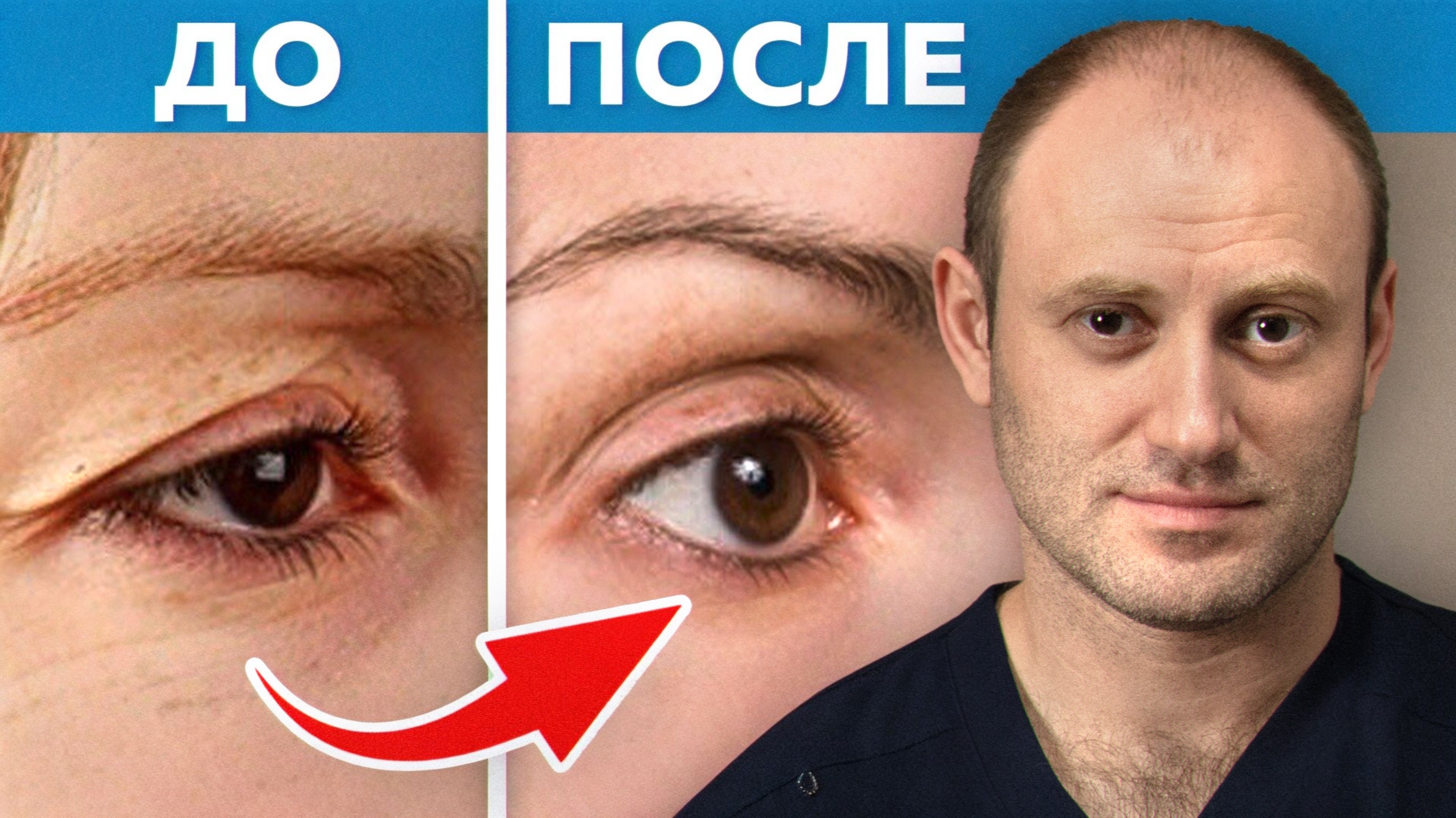 В каких случаях НЕ нужна блефорапластика? Все, что нужно знать о подтяжке нависших век!