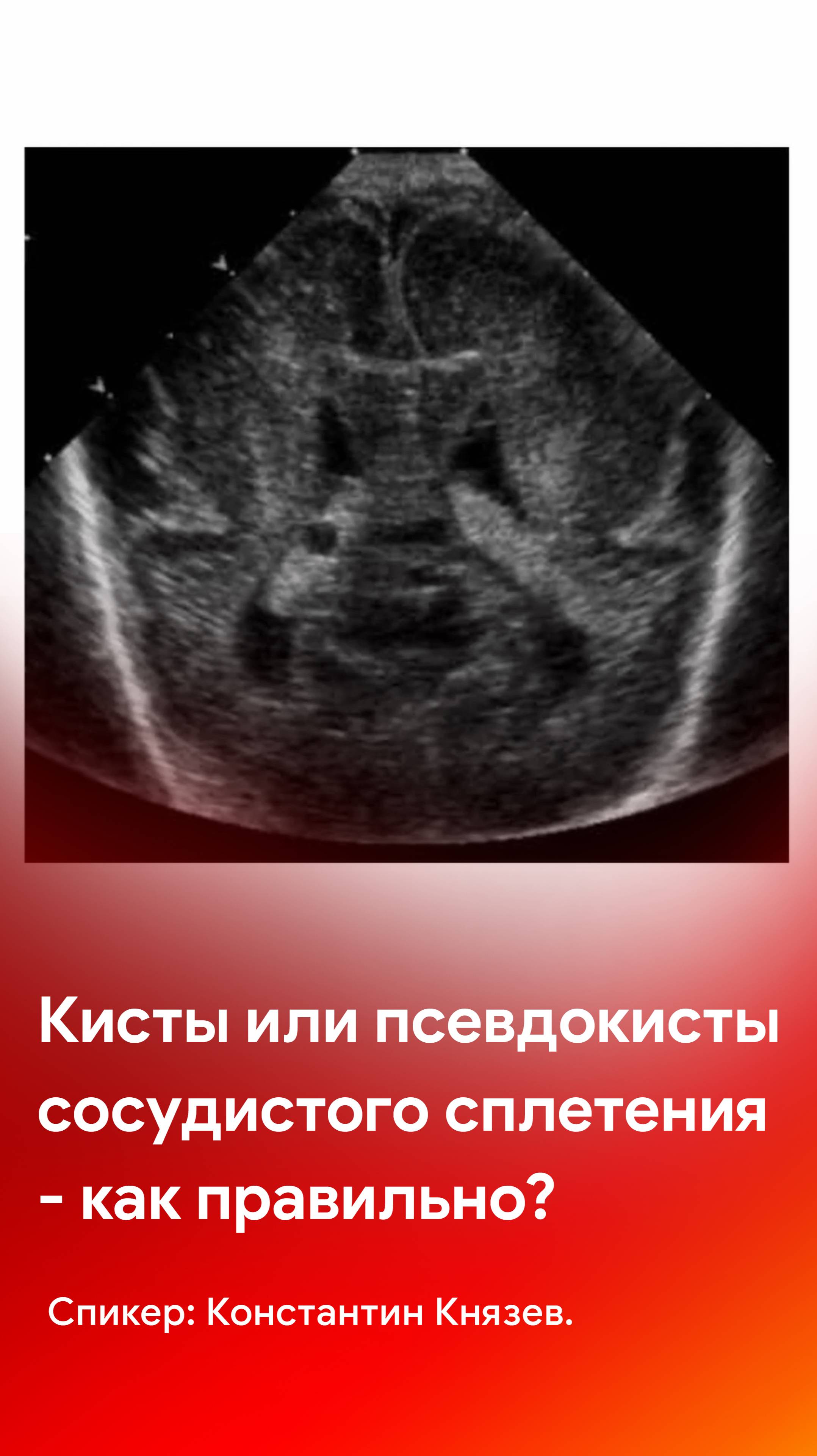 Кисты сосудистого сплетения или псевдокисты сосудистого сплетения - как правильно?
