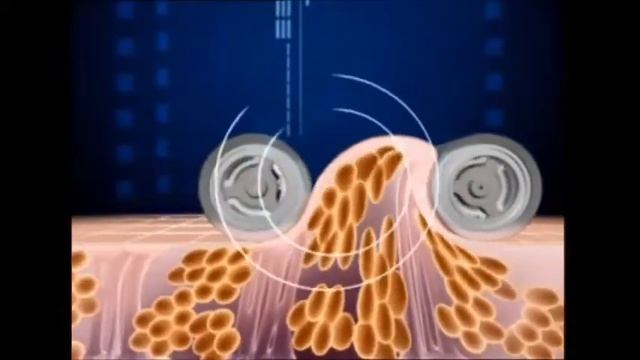 Технология LPG липомассажа