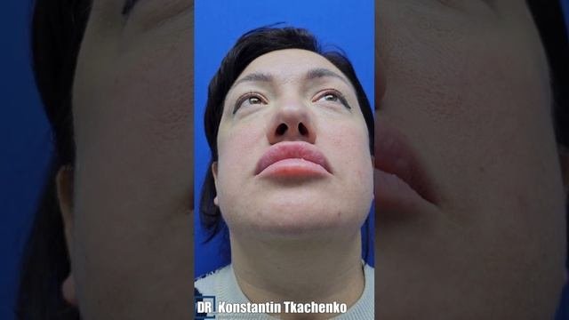 Комплексная операция. Прошло 1.5 года после верхней блефаропластики и ринопластики.