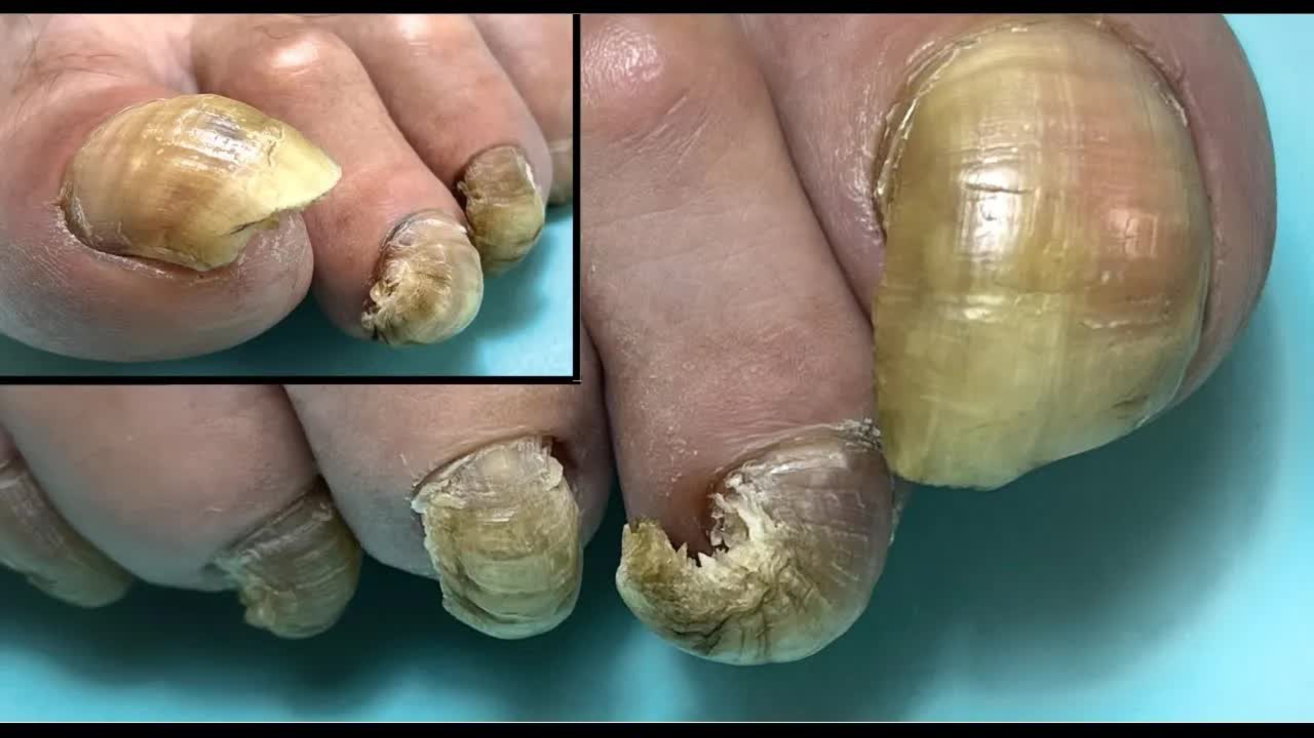 Рог-вместо ногтя🤯(птичий коготь). Сложный педикюр. Пошаговая коррекция без боли