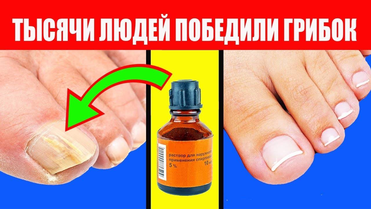 Эффективные народные средства против грибка ногтей, которые вы должны попробовать!