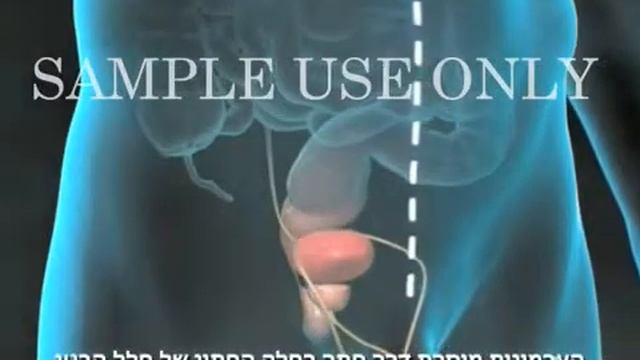 Prostate Gland Surgery  Radical Prostatectomy