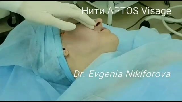 Омоложение нитями Aptos
