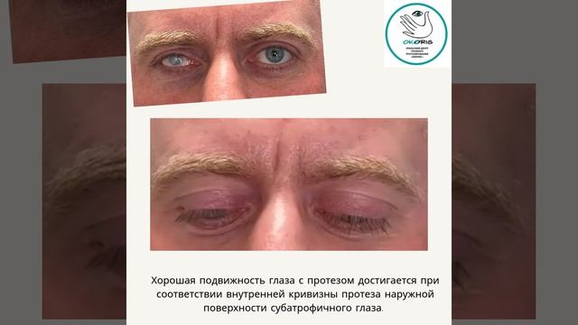 Протез на субатрофичном глазе #Shorts