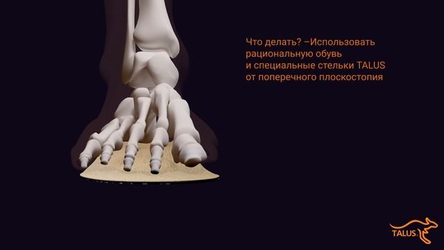 Ортопедические стельки Арт95 «Бабочка»