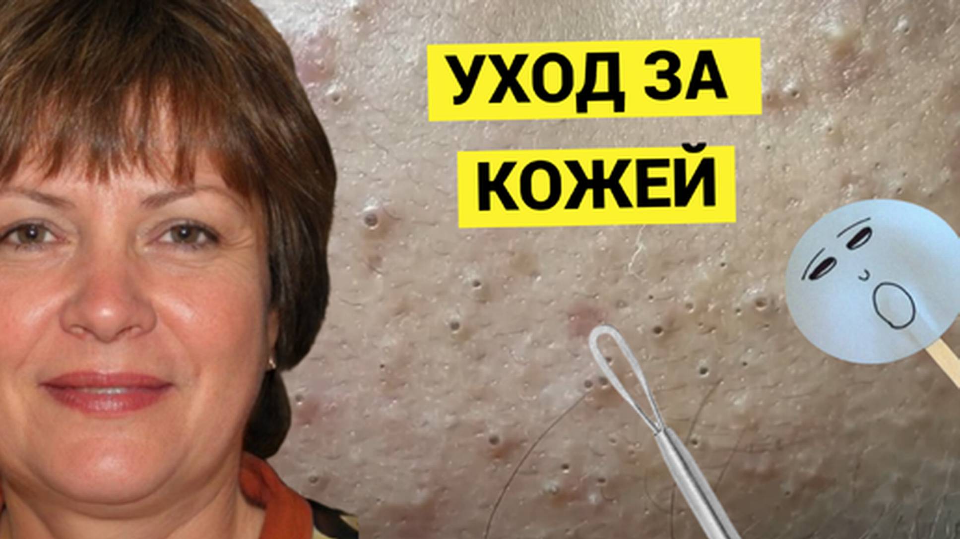 Женщина обратилась Выдавить Комедоны прямо по Адресу. Много мелких Жировичков