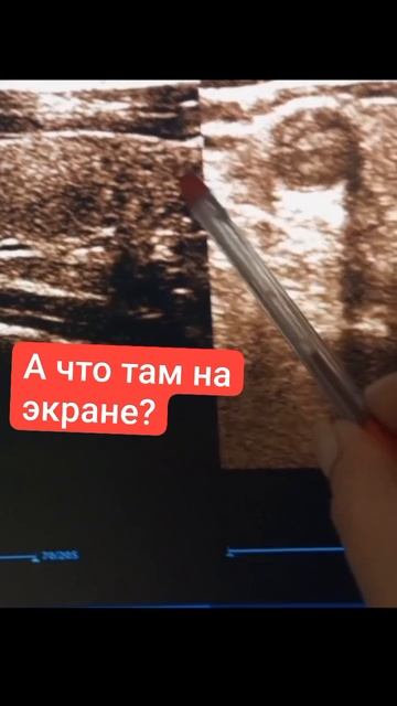 Как на экране прибора выглядит узел щитовидной железы?