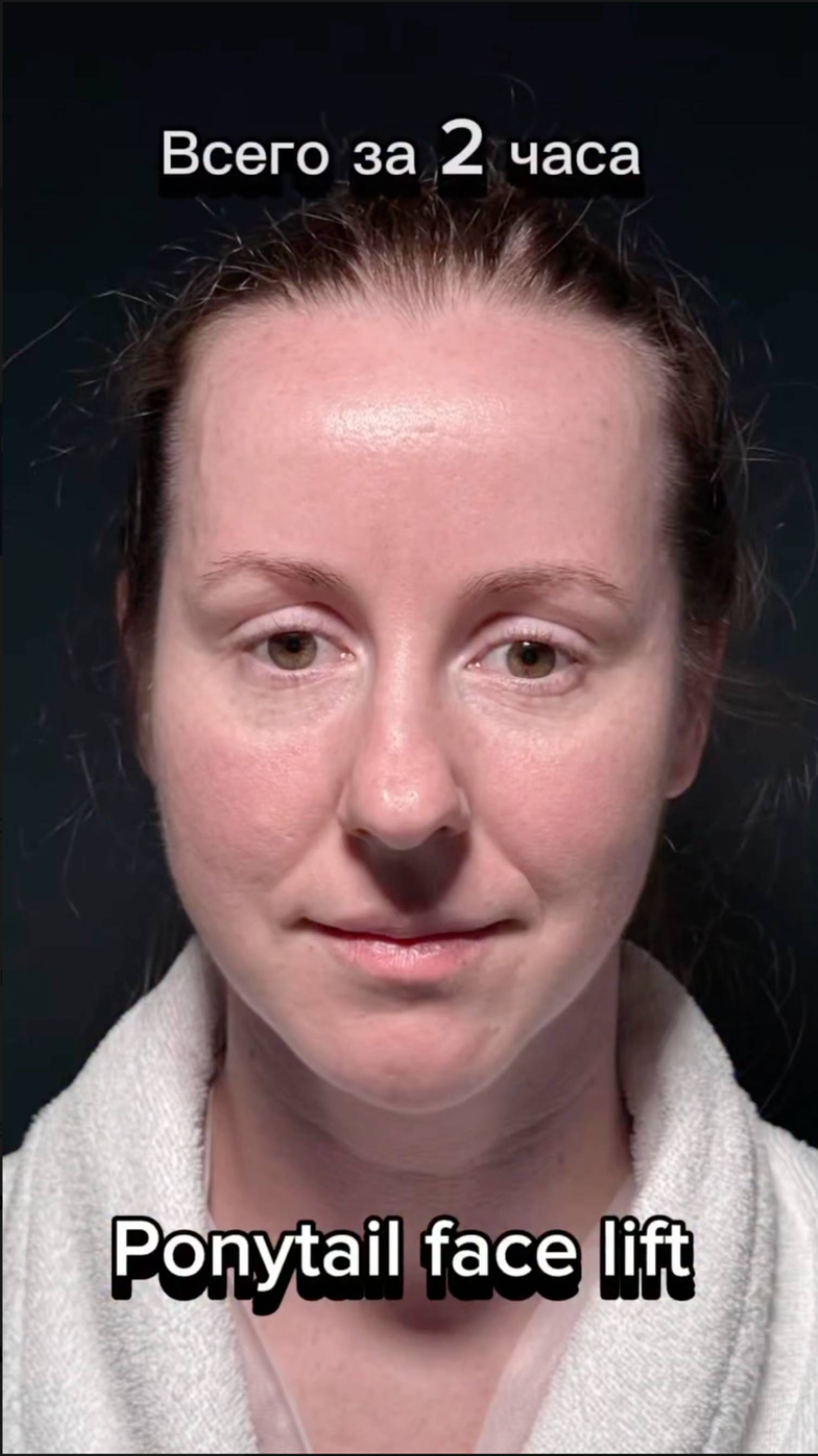 Ponytail face lift. Невидимая подтяжка лица