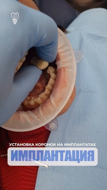 Установка коронок на имплантатах. Installation of crowns on implants. Implantation.