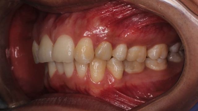 Braces missing lateral incisors, canine substitution, брекеты отсутствие боковых латеральных резцов