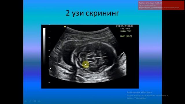 Жүктілік кезінде неше рет узи өту керек?