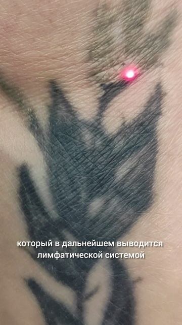 Удаление тату неодимовым лазером