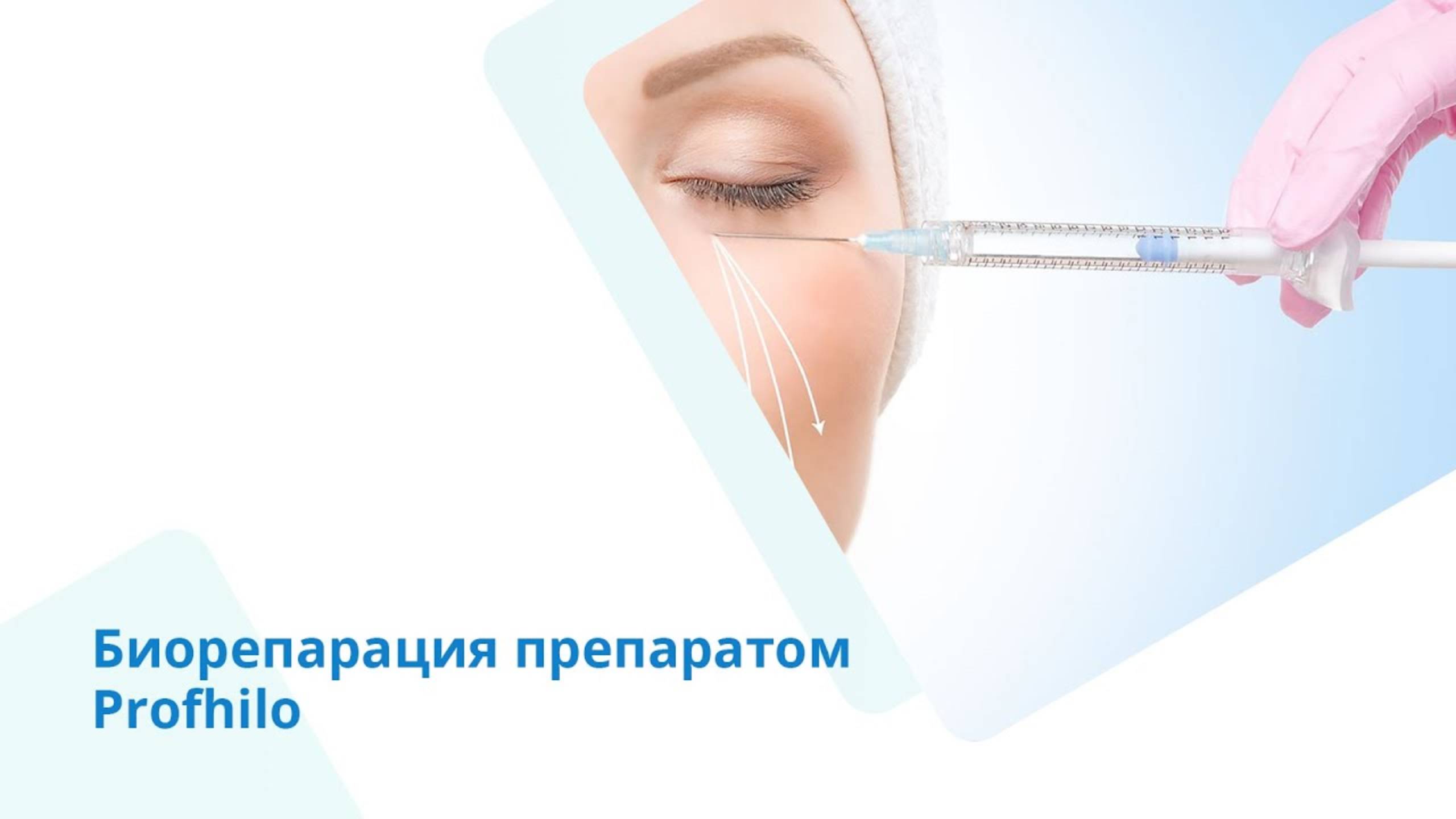 Биорепарация препаратом Profhilo (Профайло)