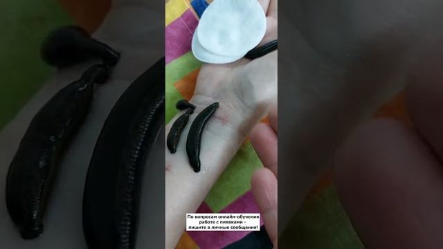 История одной руки 😉. Постановка пиявок и тейпирован?