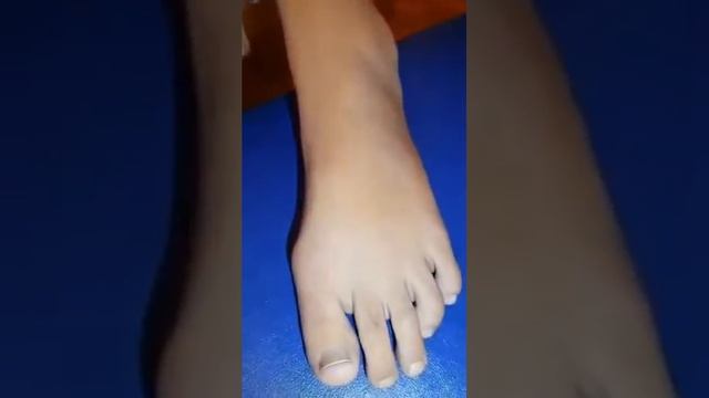 ВИТИЛИГО! ОК ДОГЛАРНИ ДАВОЛАСА БУЛАДИМИ???