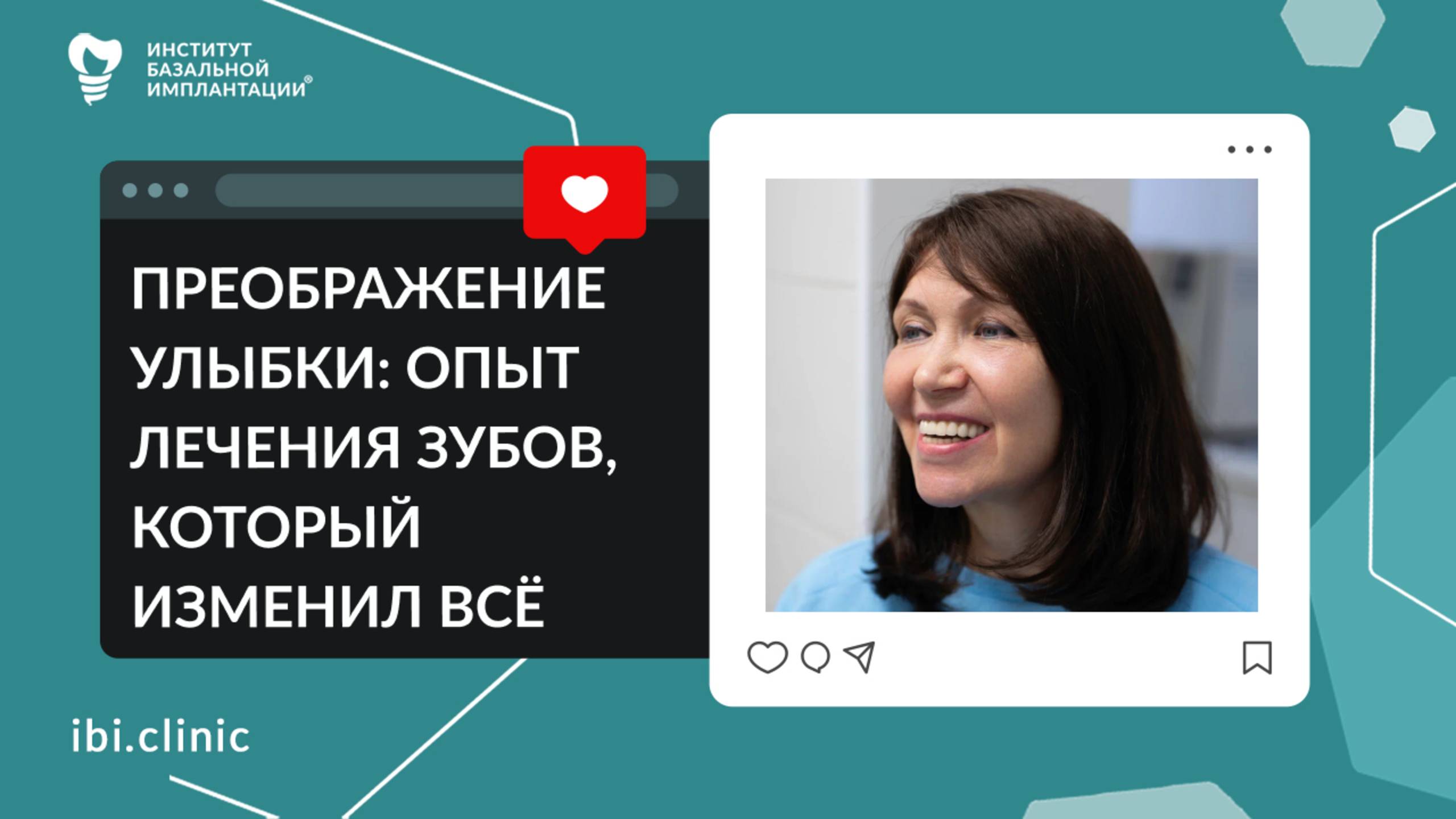 Импланция зубов в Москве - отзыв пациента спустя 5 лет лечения.