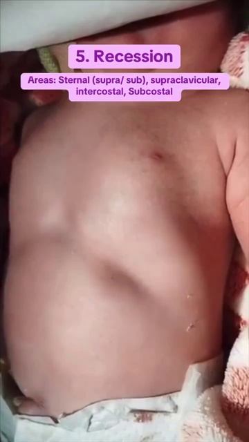 Neonatal respiratory distress signs