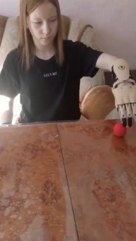 Лера получила активный протез кисти!