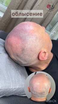 Скрываем облысение надолго! Трихопигментация. Scalp micropigmentation