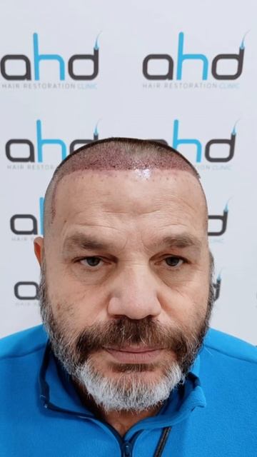2200 графтов. до и после пересадки волос в клинике докто?