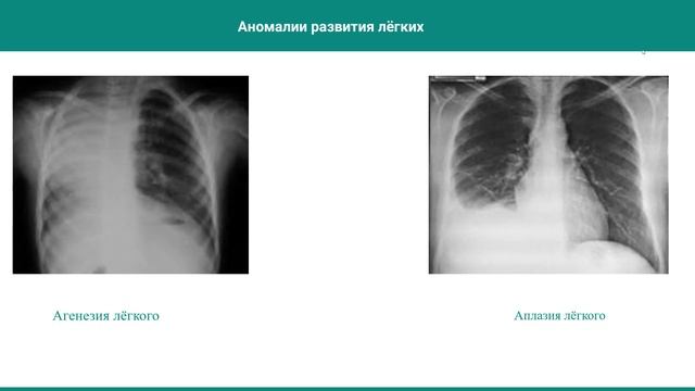 Развитие легких, варианты и аномалии. Сурфактант - роль в норме и патологии