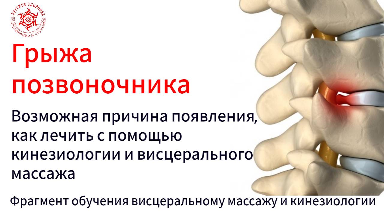 Грыжа позвоночника. Возможная причина появления, как лечить?