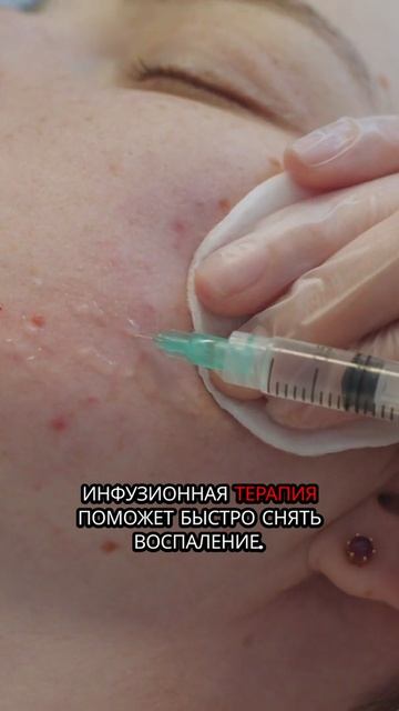 Помогает ли инфузионная терапия вылечить акне на лице