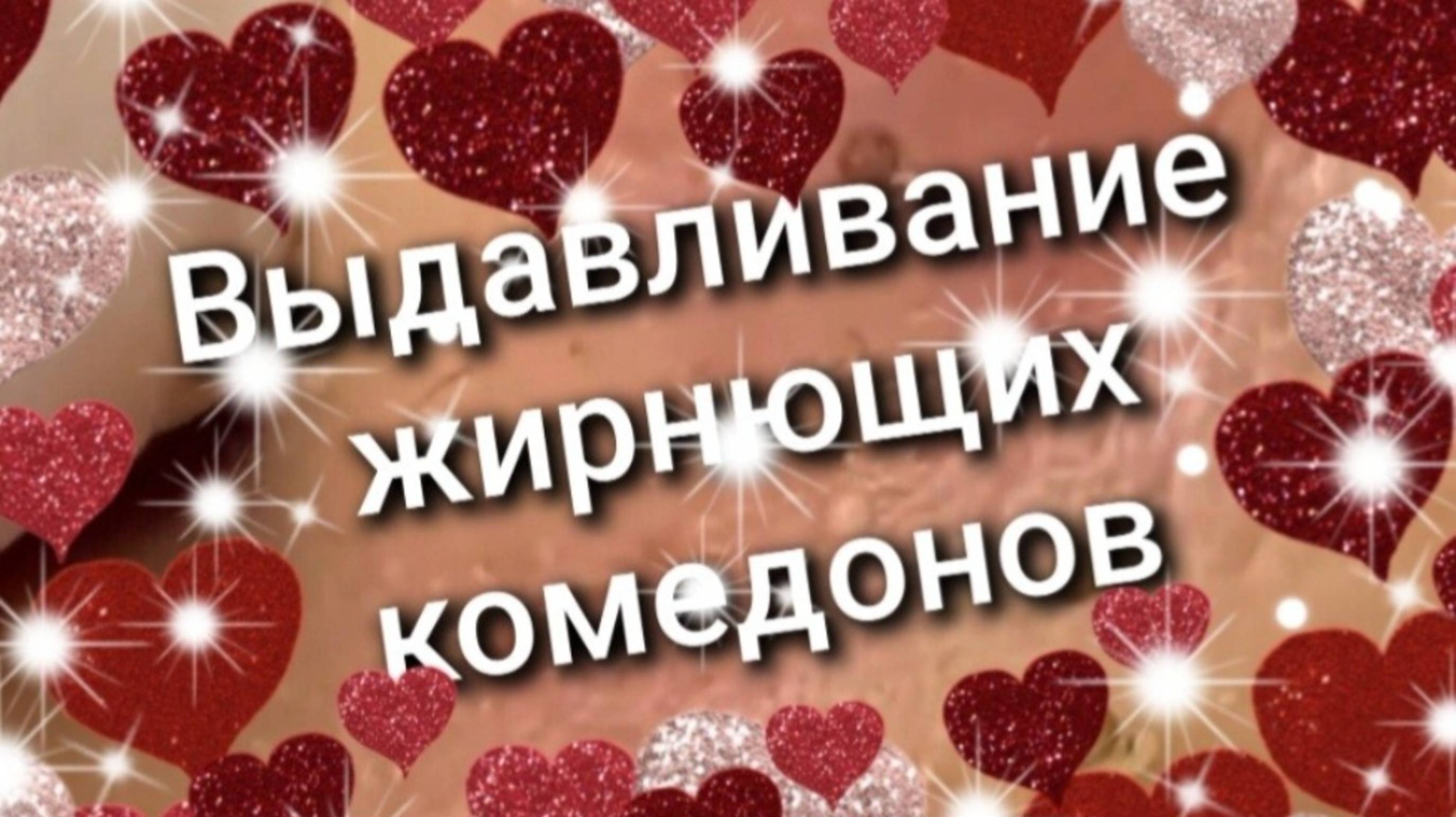 Выдавливание жирнющих комедонов