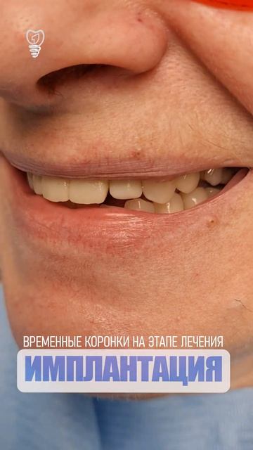 4 импланта и 5 коронок для красивой улыбки. 4 implants and 5 crowns for a beautiful smile