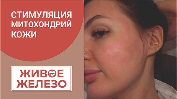 Даша после Микроигольчатого RF лифтинга + Эликсир Живое Железо наружное применение