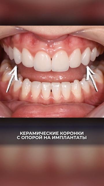 Сходила к стоматологу и не могу ПЕРЕСТАТЬ УЛЫБАТЬСЯ! #зубы #виниры #стоматолог #стоматология #улыбк