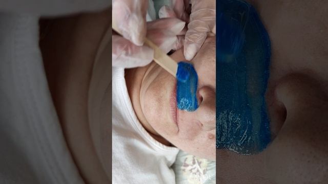 Депиляция зоны над верхней губой
