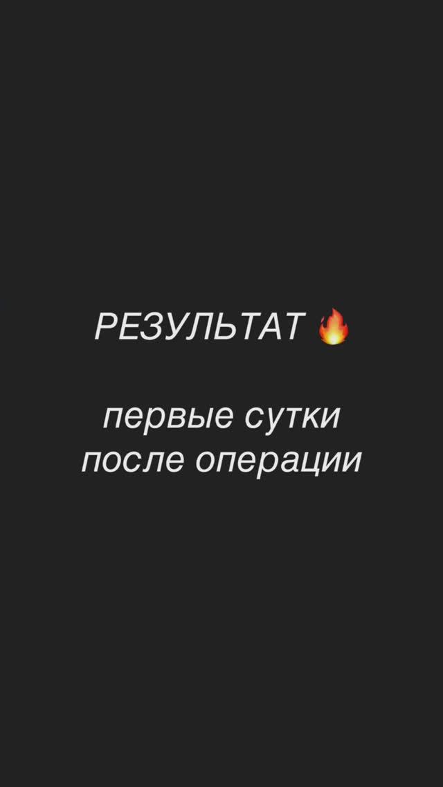 Отзыв пациентки после частичной замены двух коленных суставов за одну операцию с применением Робота