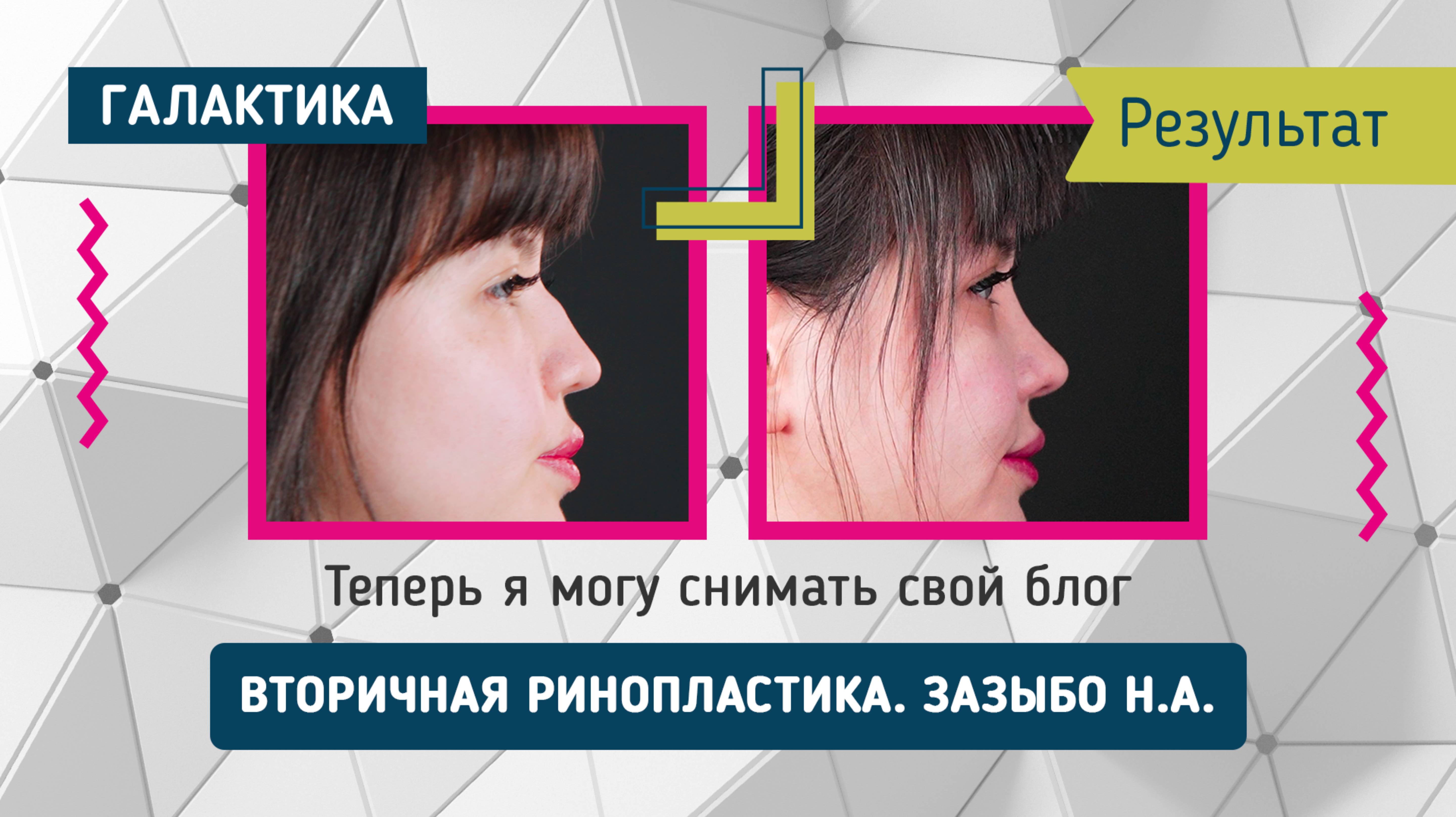 Вторичная ринопластика - результат | Зазыбо Николай Александрович