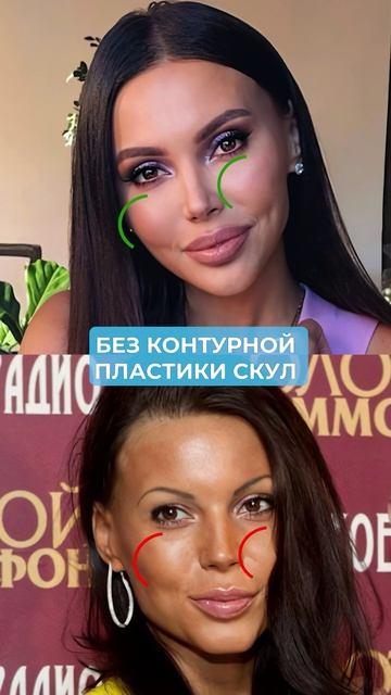 Что колола Оксана Самойлова, чтобы выглядеть ТАК МОЛОДО? #косметология #молодость #оксанасамойлова