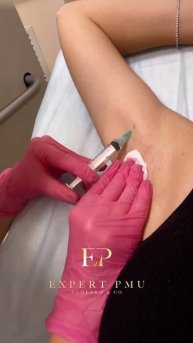 Лечение гипергидроза