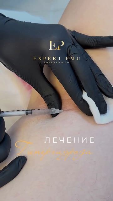 Лечение гипергидроза