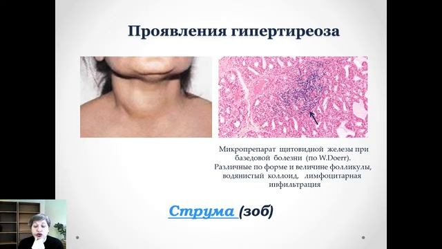 II 23. Патофизиология щитовидной и паращитовидной желез