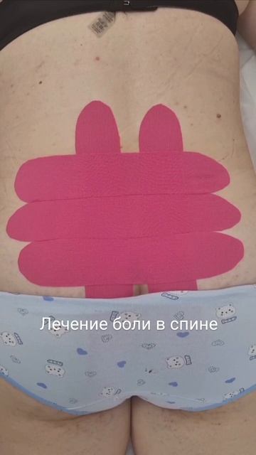 кинезиотейпирование. боль в спине. лечение. тейпирование. тейпы.