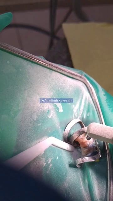 Абразивная обработка поверхности зубов 33,32 оксидом ал