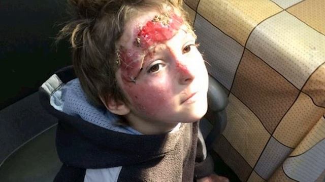 7 летний малыш сам снимал повязки... отдирая их с мясом - Екатерина Ножевникова