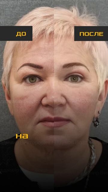 Пластика лица: что будет через 10 лет после операции?