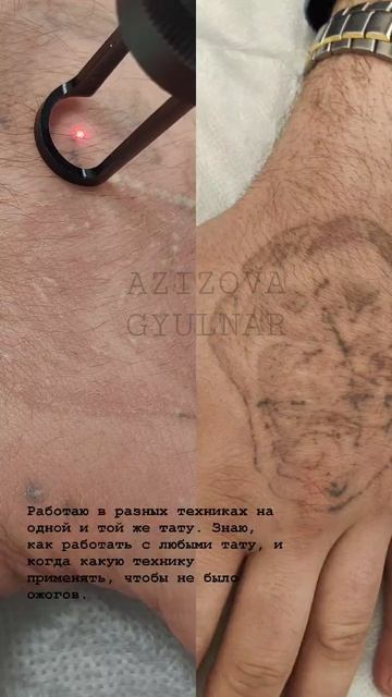 Как удалить тату безопасно?